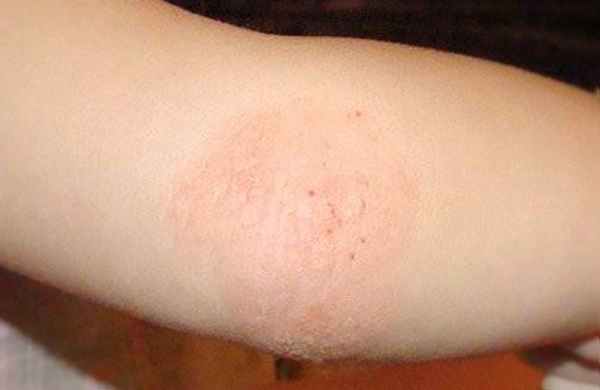 Атопический дерматит на локте