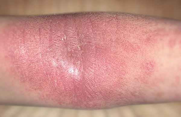 Атопический дерматит на руке