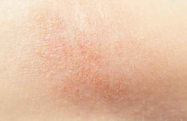 Как выглядит атопический дерматит