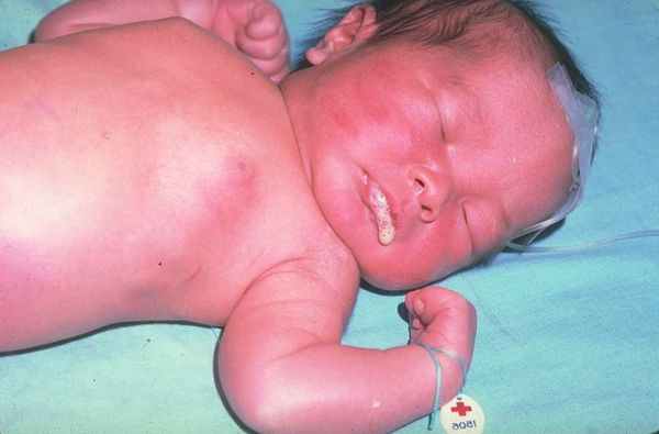 Пена у младенца с атрезией пищевода