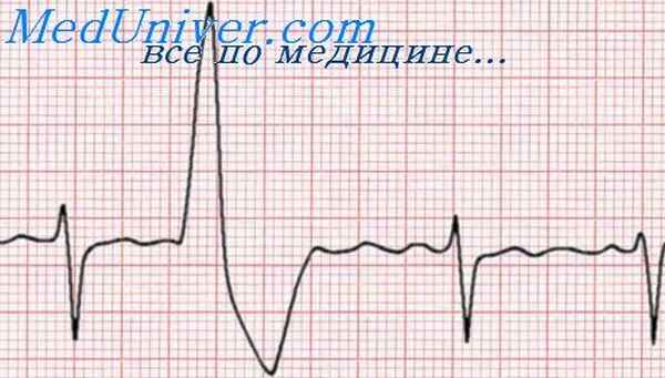 экстрасистолия