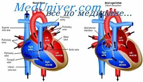 септальный дефект