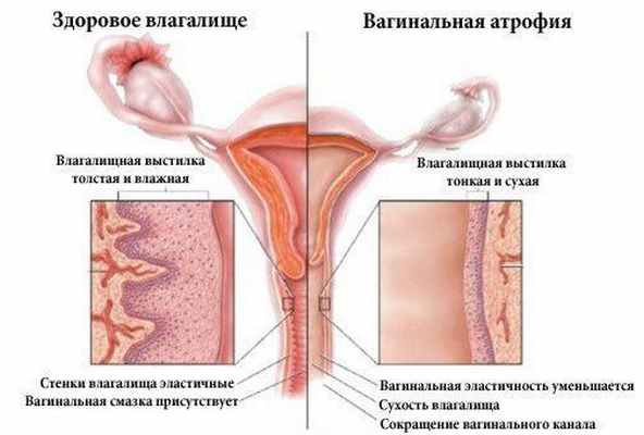 Атрофический кольпит