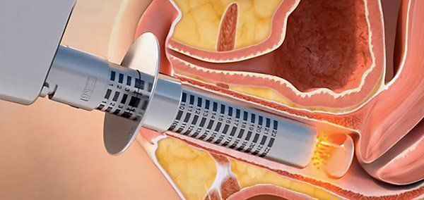 Лечение вагинальной атрофии лазером