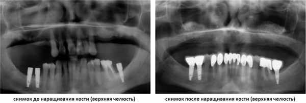 наращивание костной ткани фото до и после