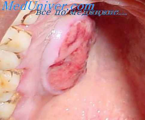 атрофия отростков