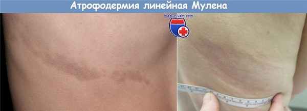 Атрофодермия линейная Мулена
