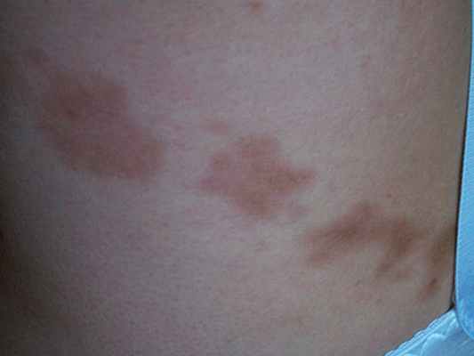 Атрофодермия