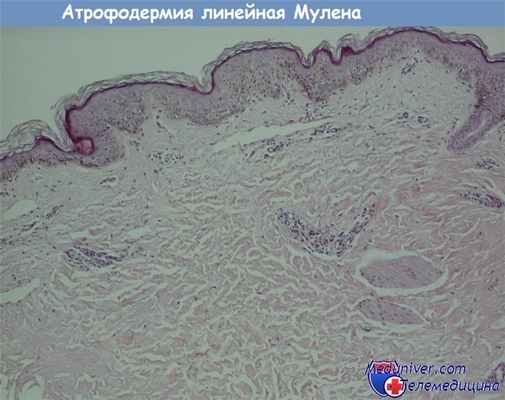 Гистология атрофодермии линейной Мулены