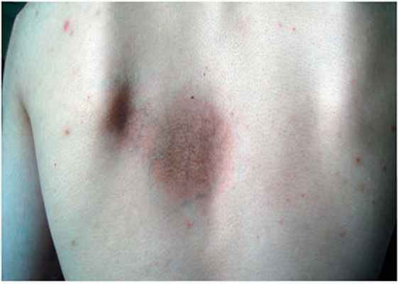 Пазини–Пьерини