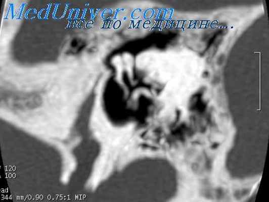 аудиометрия при отоспонгиозе