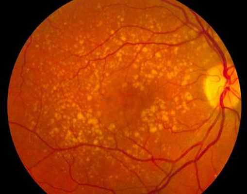 Дегенерация желтого пятна сетчатки глаз: симптомы и терапия