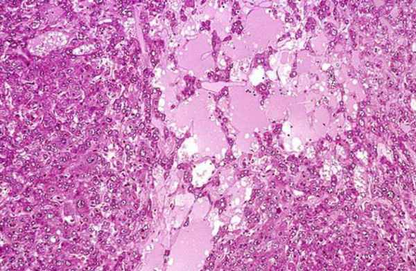 Дегенерация. Дегенерация - примеры