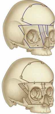 Гипертелоризм - что это? Отвечаем на вопрос. Причины и симптомы