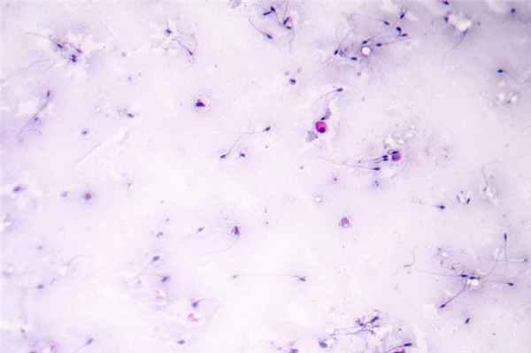 Азооспермия