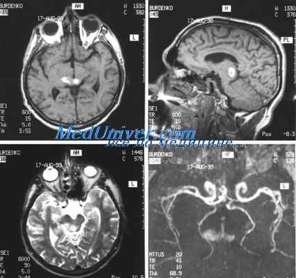 бактериальный менингит