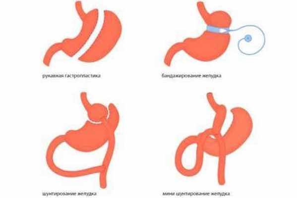виды бариатрической операции