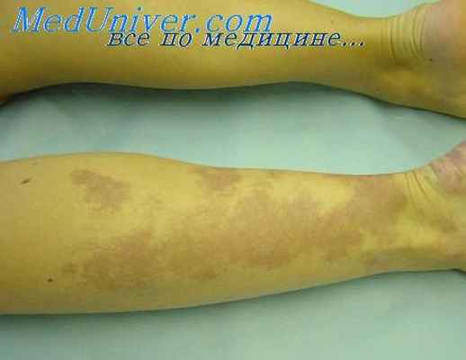 ангиоматоз