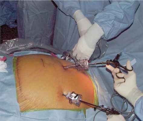 лечение бедренной грыжи фоторезультат