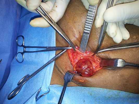 лечение бедренной грыжи