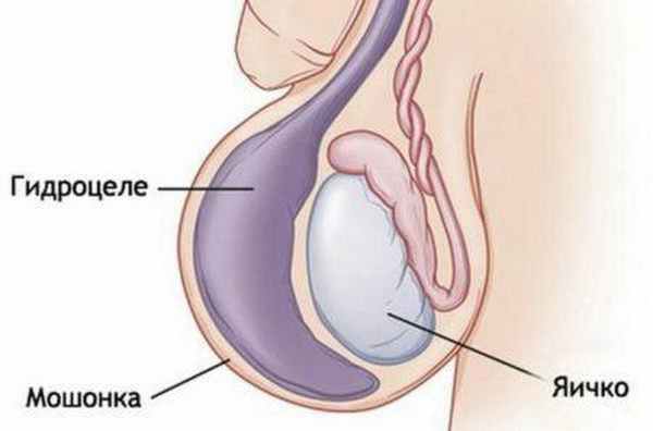 Гидроцеле