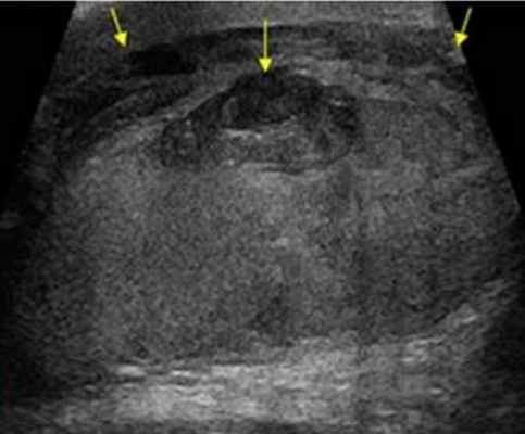 УЗИ после травмы мошонки: гематоцеле по краям, кровоизлияние в тело яичка в центре