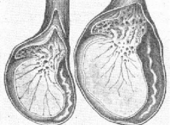 Увеличение размеров яичка при орхите