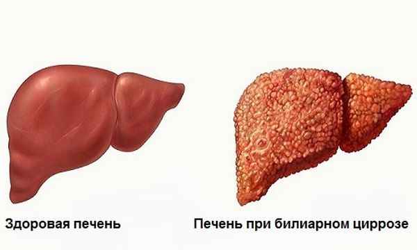 biliarnyj-tsirroz-pecheni.jpg