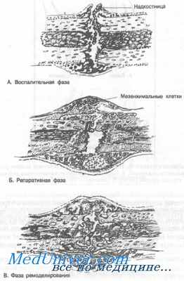 биомеханика перелома