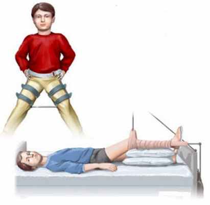 Болезнь Пертеса