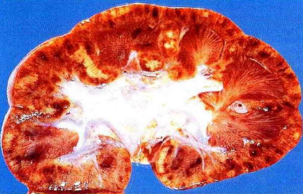 Почка при быстропрогрессирующем гломерулонефрите (макропрепарат)