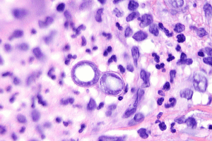 Бластомикоз