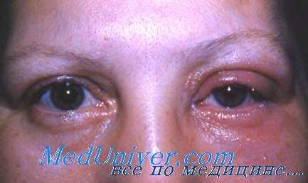 помутнение хрусталика от фтора