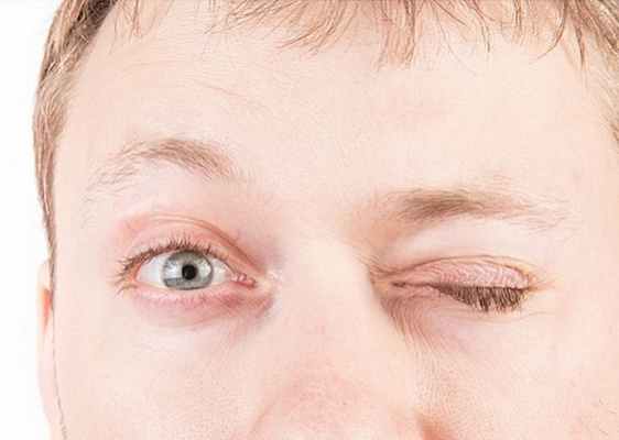 Блефароспазм