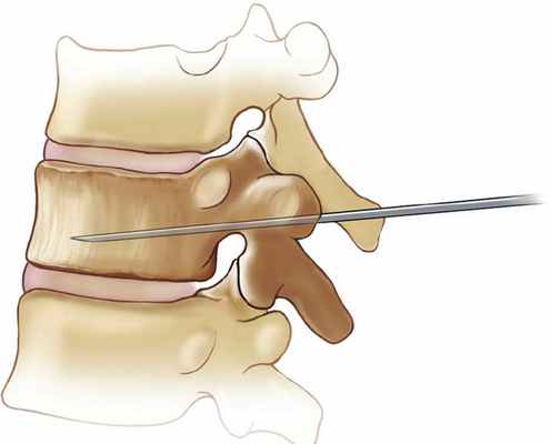 межреберные нервы лечение