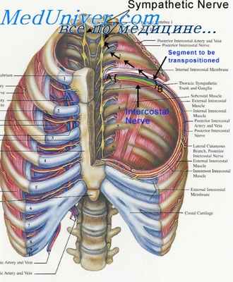 блокада межреберных нервов