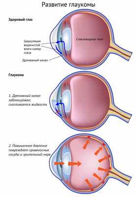 Развитие глаукомы.jpg