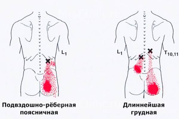 Миофасциальный синдром и триггерные точки