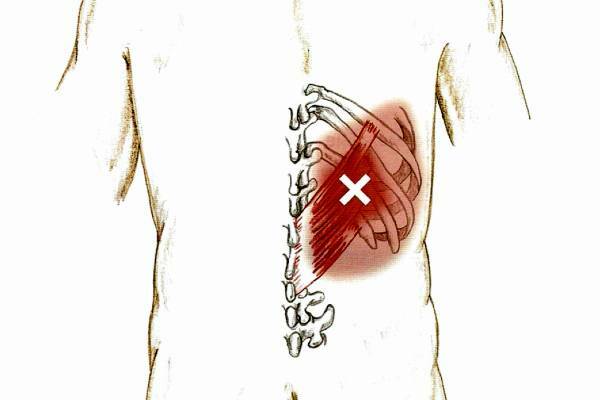 Симптомы миофасциального синдрома