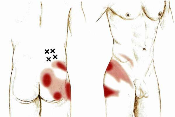 Локализация миофасциального синдрома