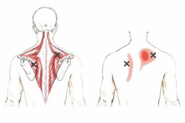 Миофасциальный болевой синдром что такое