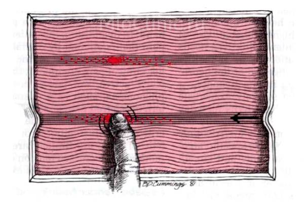 Миофасциальный синдром в каких тканях бывает