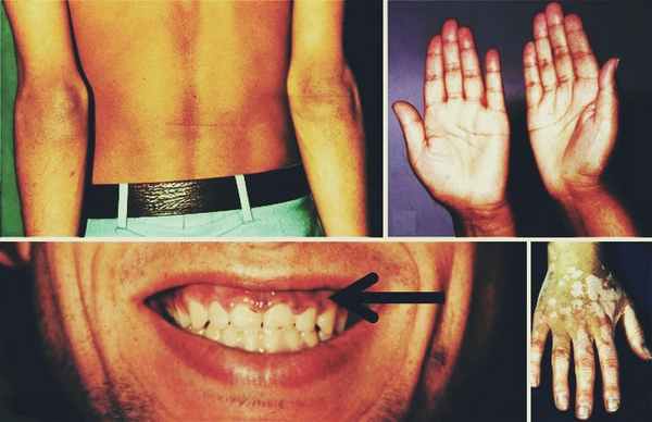 симптомы болезни Аддисона 