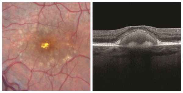 Патологическое скопление в области макулы при вителлиформной макулодистрофии взрослых