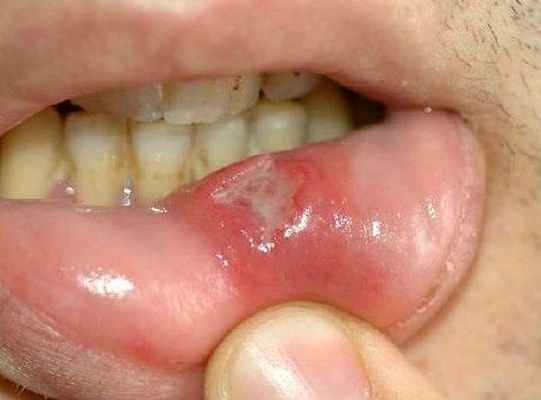 Болезнь Бехчета