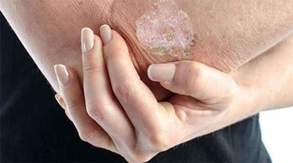 Болезнь Боуэна