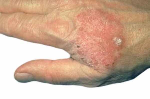 болезнь Боуэна фото-2