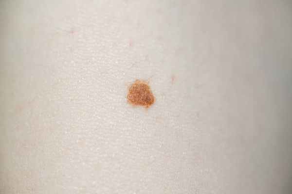 Болезнь Боуэна