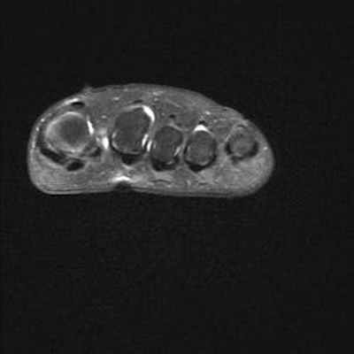 Осложнения болезни Фрейберга DP FS Coronal