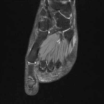 Осложнения болезни Фрейберга DP FS Axial